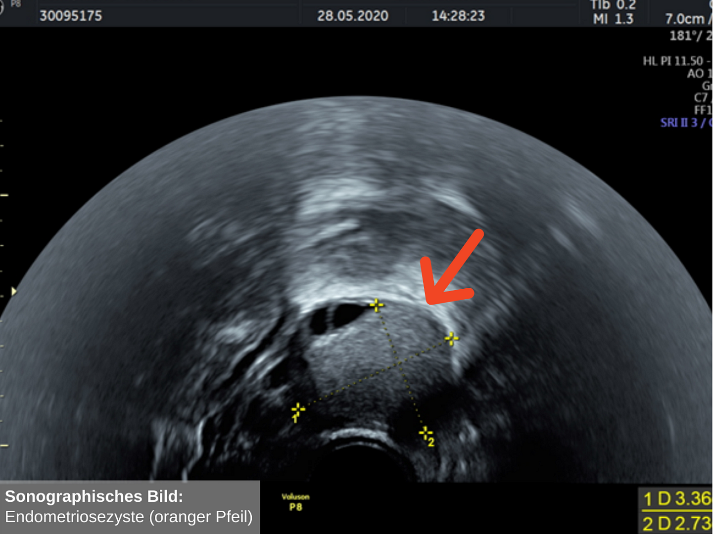 Endometriose